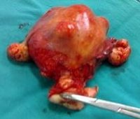 Саркома матки