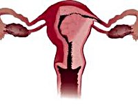 Рак тела матки