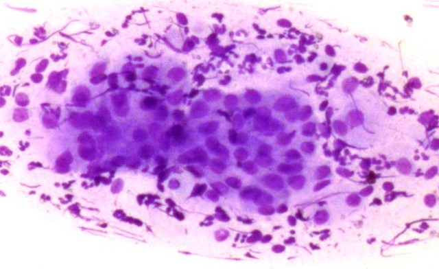 Что такое цитограмма шейки матки