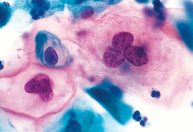 Что такое цитограмма шейки матки