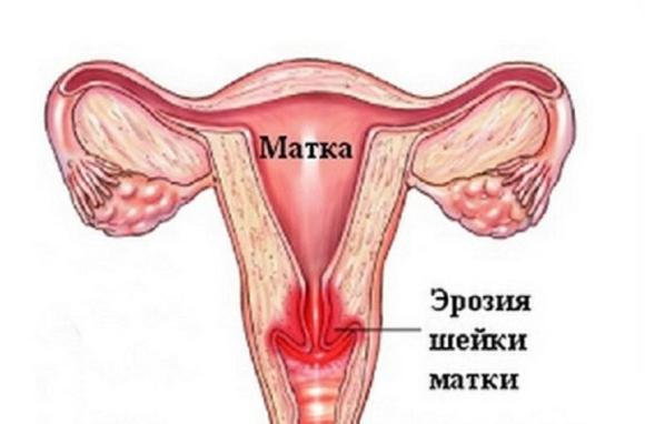 признаки эрозии шейки матки