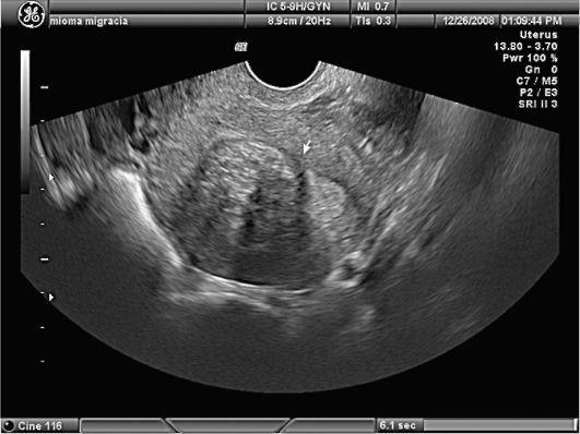диагностика саркомы матки